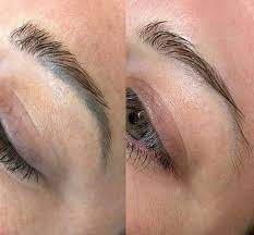 eyebrow tattoo removal laser remedy