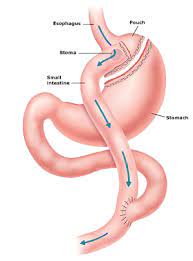 gastric byp surgery and