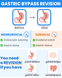 gastric byp revision why and when