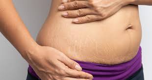 uncovering stretch marks your