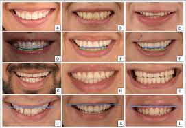 smile arc smile types and upper lip