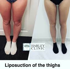 7 aftercare tips for thigh lift surgery