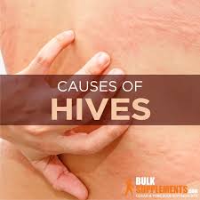 hives symptoms causes treatment