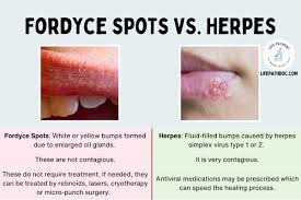 fordyce spots vs herpes pictures and