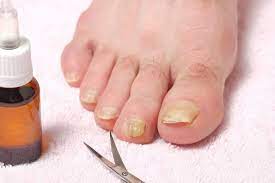 natural remedy for toenail fungus