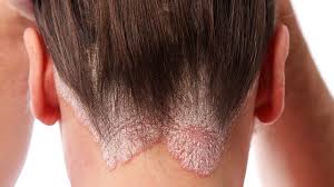 what is scalp psoriasis