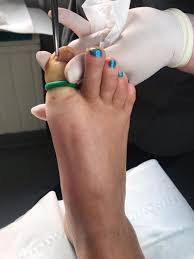nail surgery happy feet podiatry