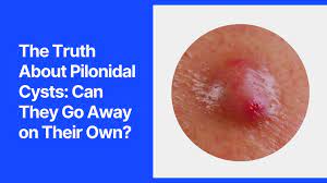 the truth about pilonidal cysts can