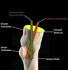 al view of a left proximal femur