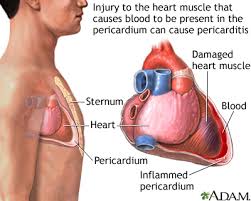 pericarditis after heart