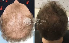 Zajmujemy się dolegliwościami związanymi z ludzkimi włosami i skórą głowy. Trychologia Warszawa Trycholog Klinika Przeszczepu Wlosow