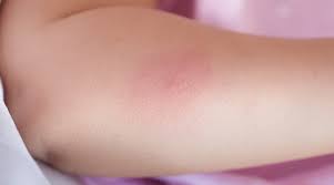 bed bug bites causes symptoms and