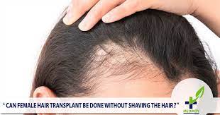 But keep in mind that moisture is the key to hair growth. Female Hair Transplant Be Done Without Shaving The Heir