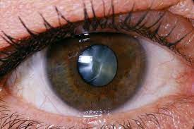 Concerning signs of infection are significant decrease in vision (compared to the first day or two after cataract surgery), significant pain lasting over 30. What To Expect With Cataract Surgery