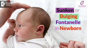 bulging sunken soft spots on baby s