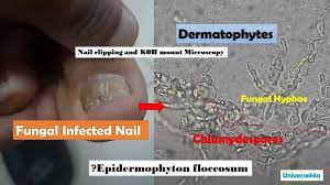 fungal nail infection introduction