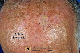 actinic keratosis treatment