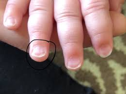 vertical ridges on finger nail babycentre