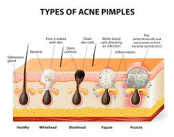 Acne Diagram 2 Acne Causes Homemade Acne Treatment How