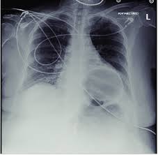 The lungs' interiors are open to the outside air, and being elastic, therefore expand to fill the increased space. Chest X Ray Showing Herniation Of The Gas Distended Stomach Overlying Download Scientific Diagram