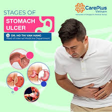 ses of stomach ulcers