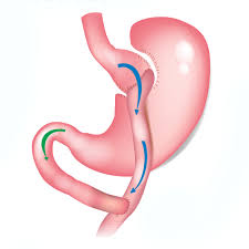 gastric byp dr jason maani