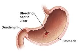 Image result for peptic ulcer bleeding