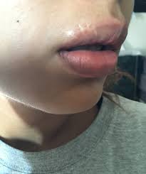 upper lip from a dog bite