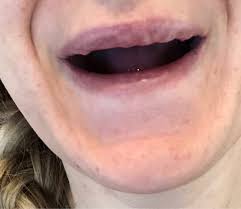 juvederm ultra plus xc lip injections