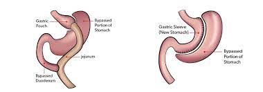 bariatric surgery what are my options