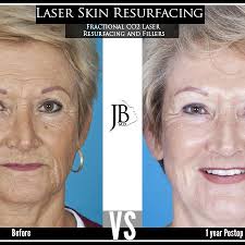 co2 laser skin resurfacing with