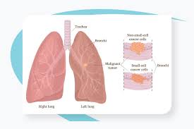 lung cancer treatment specialists