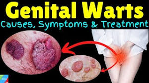warts symptoms causes