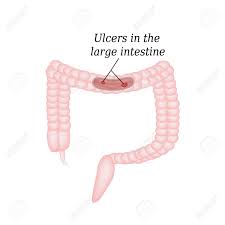 Ulcerative colitis, a condition where ulcers are in colon or ulcers in large intestine. Ulcer In The Intestine Ulcers In The Colon Illustration On Royalty Free Cliparts Vectors And Stock Illustration Image 43944090
