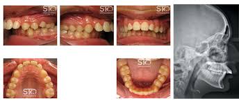 Complete guide for overbite problem. Non Surgical Orthodontics In Scarborough Sto Orthodontists