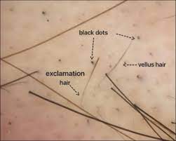 An old razor does not cut the hairs away from the skin but yanks them out, causing minimal blood loss that causes the black dots in hair follicles after shaving. Dr Donovan S Hair Loss Articles 2011 2021 Donovan Hair Clinic