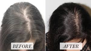 Platelet Rich Plasma Treatment for Hair Loss: Here's What to Know | Allure