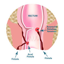 fistula causes symptoms