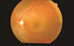 Image result for icd 10 code for central serous chorioretinopathy