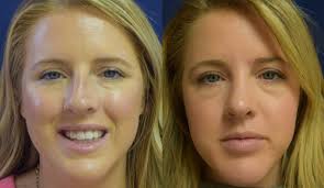 nose job recovery the best