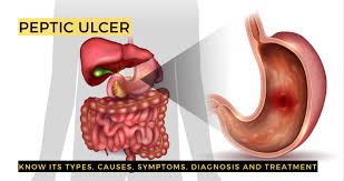 peptic ulcer types causes symptoms
