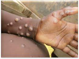 Human monkeypox is a zoonotic viral disease that occurs primarily in remote villages of central and west africa in proximity to tropical rainforests where there is more frequent. Monkeypox