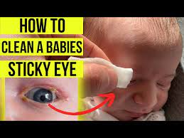how to treat a sticky eye in es