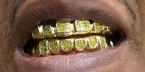 24k rose gold plated grillz. Gold Grillz Custom Gold Teeth Big Dawgs Bling