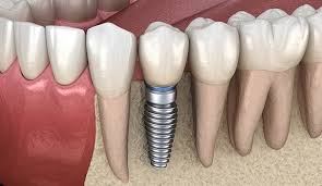 implanturi dentare rapide
