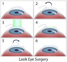 laser vision correction helix eye care