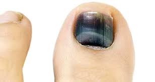 black toenail symptoms causes