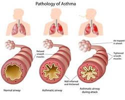Shake it for 5 seconds. Asthma Physiopedia