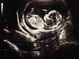 But no matter how many twin pregnancy symptoms you're experiencing, you need an ultrasound to determine twin pregnancy facts you need to know. Can You Tell If You Re Having Multiples Before The Ultrasound
