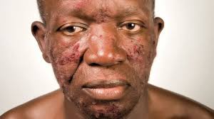 4 hiv skin rashes photos pictures and